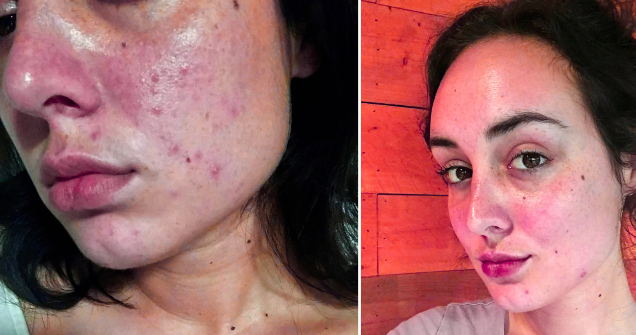 If I Stop Drinking Soda, Will My Skin Clear Up 2 Untitled design 2025 11 11T105506.340